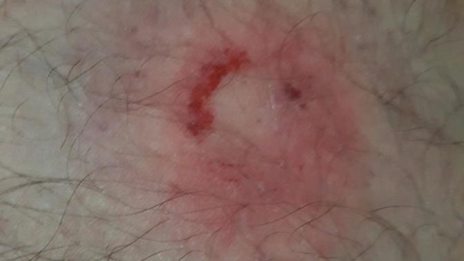 Paintball yaraları nasıl geçer?