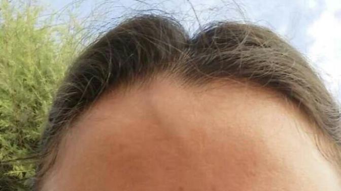 Alnımda birden böyle damar çıkmaya basdı neden acaba?