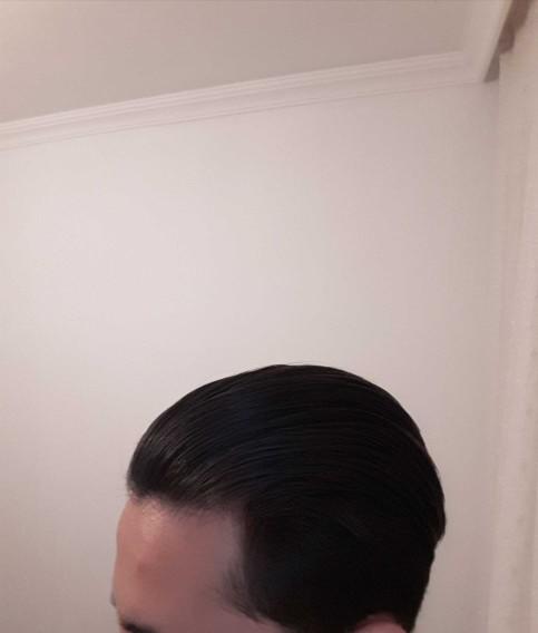 Saç dökülmesi varmı?