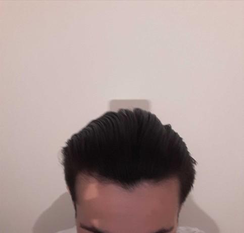 Saç dökülmesi varmı?