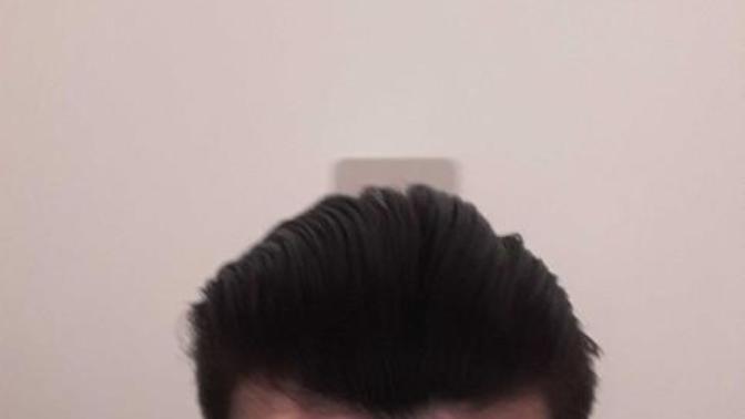 Saç dökülmesi varmı?