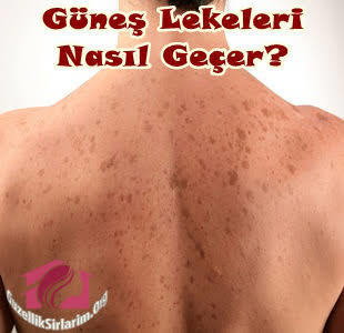 omuzdaki gunes lekeleri nasil gecer aglicam ya ?