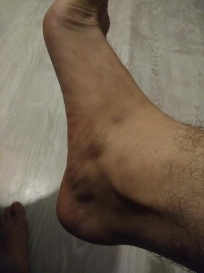 Ayagımda bir çukurluk var bu ne?