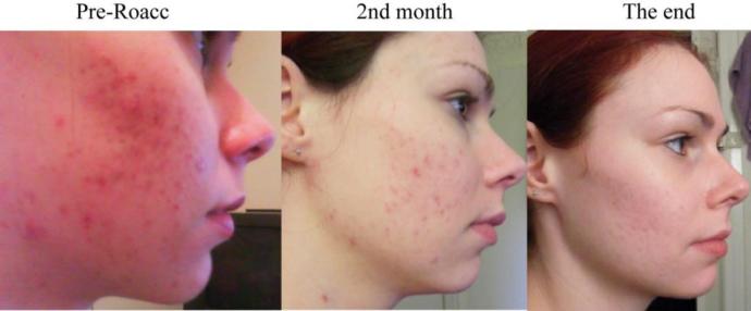 roaccutane tedavisi ?
