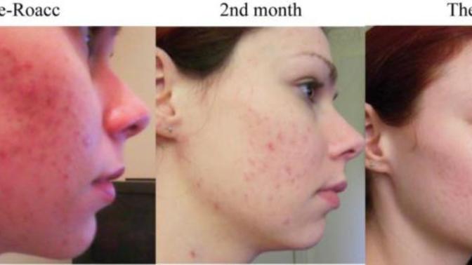 Roaccutane tedavisi?