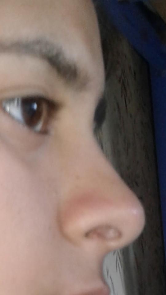 Burnum farklı açılardan çok çirkin duruyor bu genel mi yoksa burun kemiğimde mi  bir  problem var?