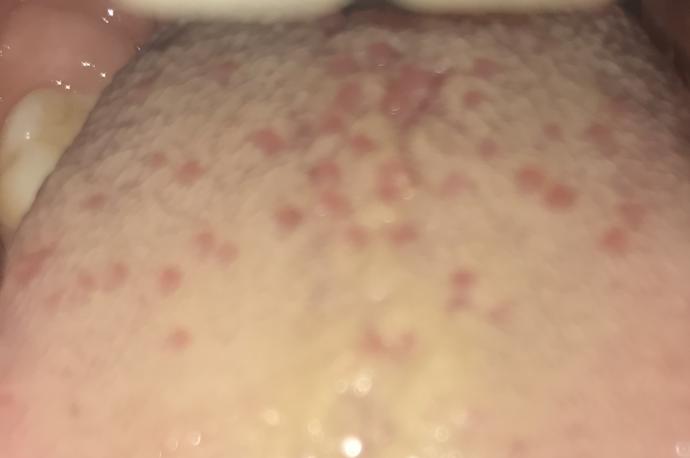 Lütfen bilgisi olanlar yardım Etsin bu neden olur? Hpv mi?