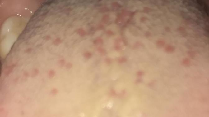 Lütfen bilgisi olanlar yardım Etsin bu neden olur? Hpv mi?