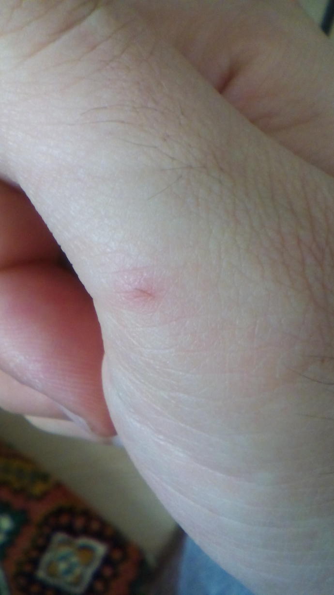 (Resimli) Elimi pasli bir tel cizdi. Acaba tetenoz olur muyum?