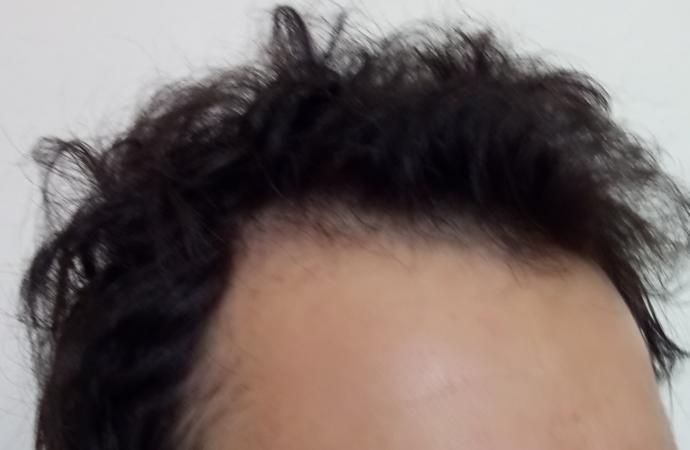 Alın Açıklığı Düzelir mi? 
