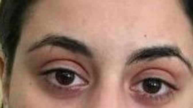 Bu şekilde içine çökmüş göz için yapılabilecek ne var?