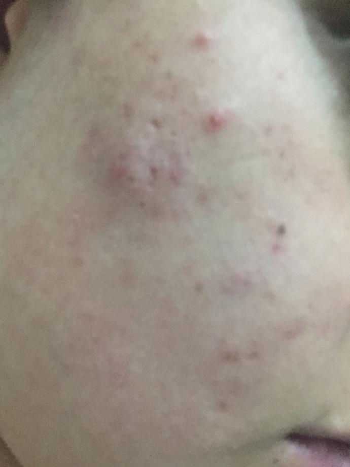 Yüzüm çok kötü oldu ne yapabilirim çok moralim bozuluyor kremler fayda etmiyor bide roaccutane kullandım yeniden sivilce çıkıyor?