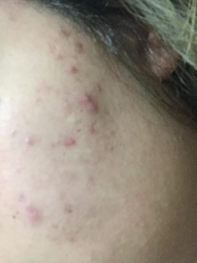 Yüzüm çok kötü oldu ne yapabilirim çok moralim bozuluyor kremler fayda etmiyor bide roaccutane kullandım yeniden sivilce çıkıyor?