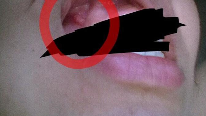 Diş etimde bunlar çıktı (resimli). Ön dişimde kenarda dolgu var çok acıyor. Arkada bir dişim de sızlıyor. ne yapabilirim?