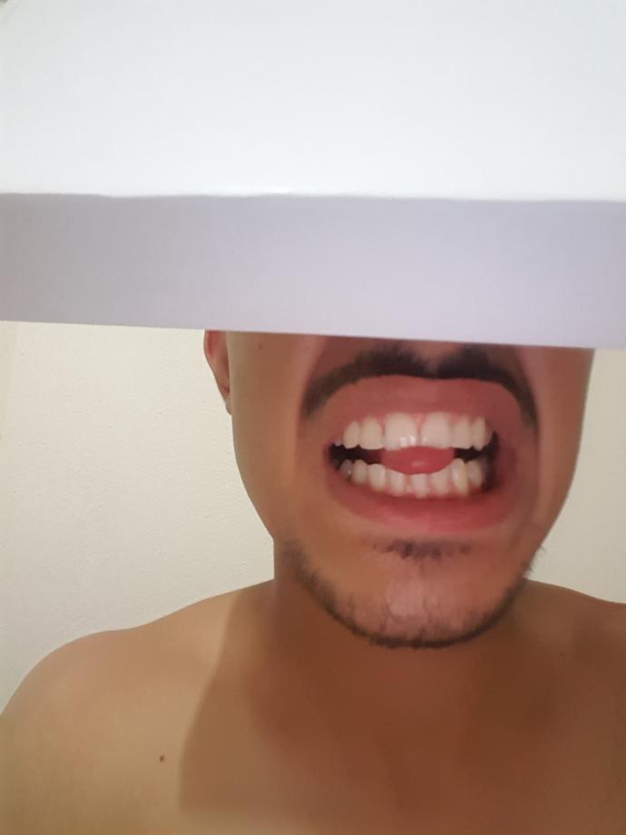 Ön dişlerim çok mu ayrık? 19 yaşındayım birleşir mi ilerde?