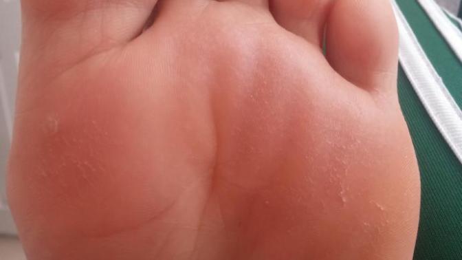 Ayaklarımın altı böyle olmuş. Duzelmesi icin ne yapabilirim?