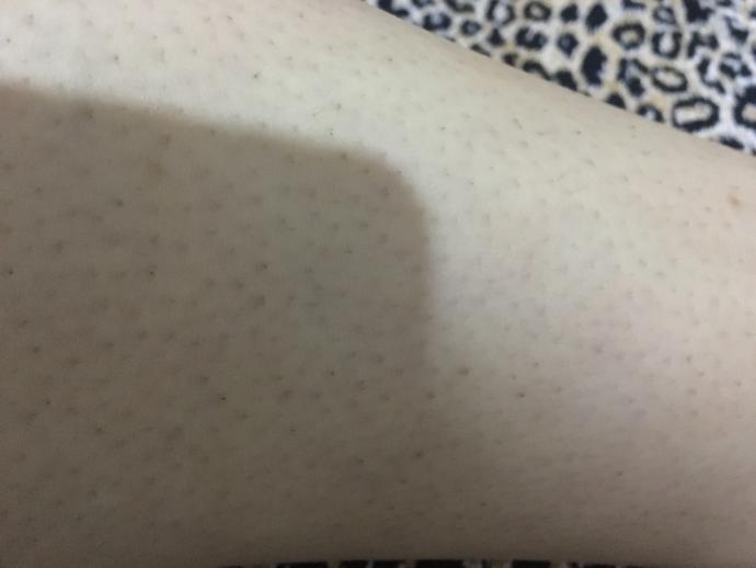 Fotoğrafa bakar mısınız bacağımı nasıl kurtarabilirim bu batıklardan?