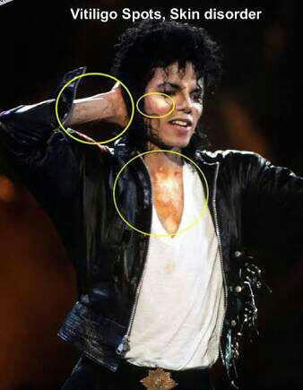 michael jackson da bir vitiligo hastasiydi. biliyormuydunuz??