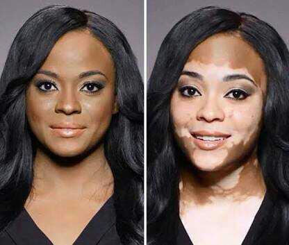 michael jackson da bir vitiligo hastasiydi. biliyormuydunuz??