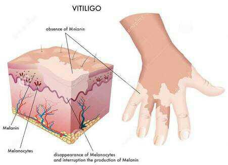 michael jackson da bir vitiligo hastasiydi. biliyormuydunuz??