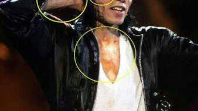 Michael jackson da bir vitiligo hastasiydi. biliyormuydunuz?