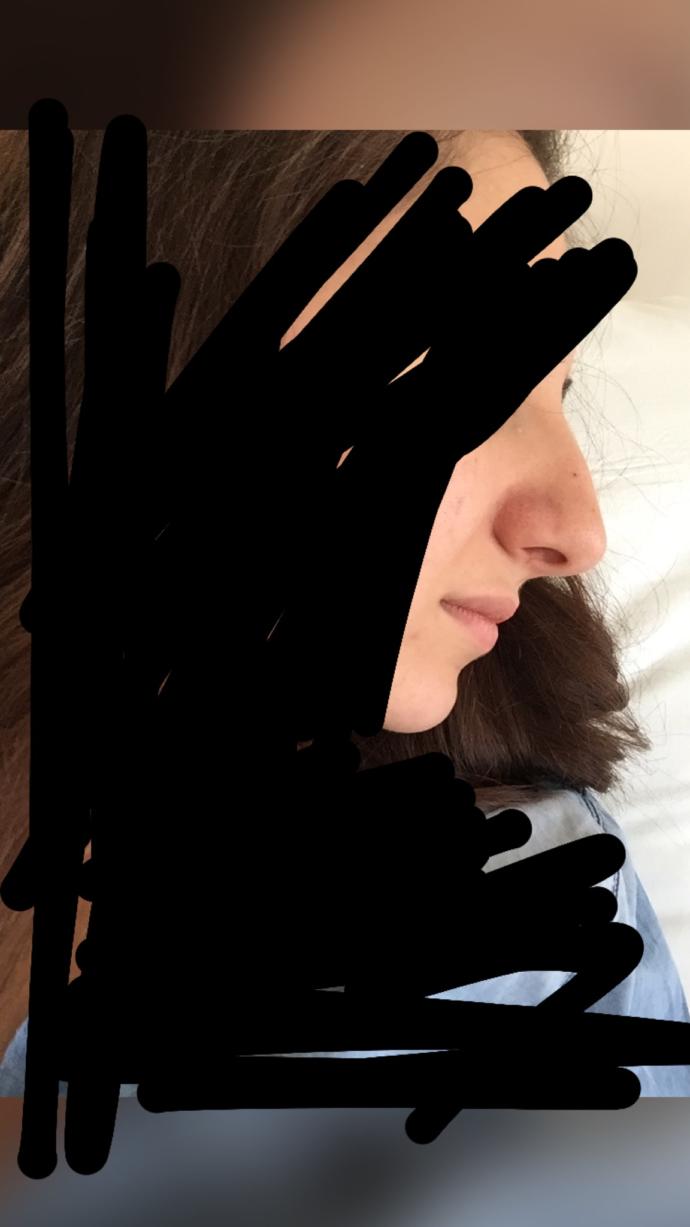 4 gün önce estetik oldum kaç güne düzelirim nasıl olmus ? resimli?