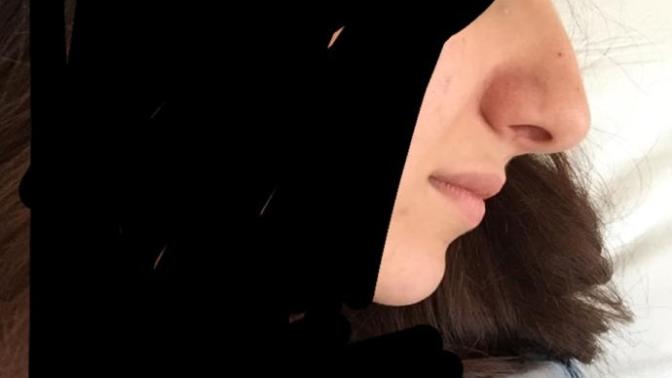 4 gün önce estetik oldum kaç güne düzelirim nasıl olmus? resimli?