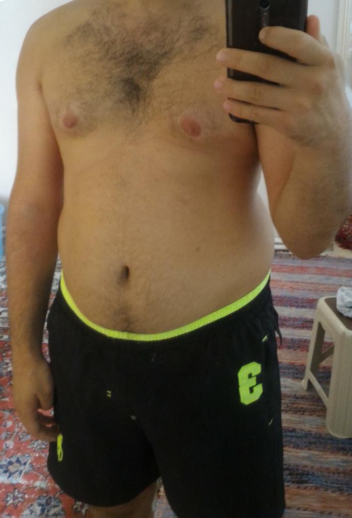 Bendeki jinekomasti sadece sporla geçer mi?