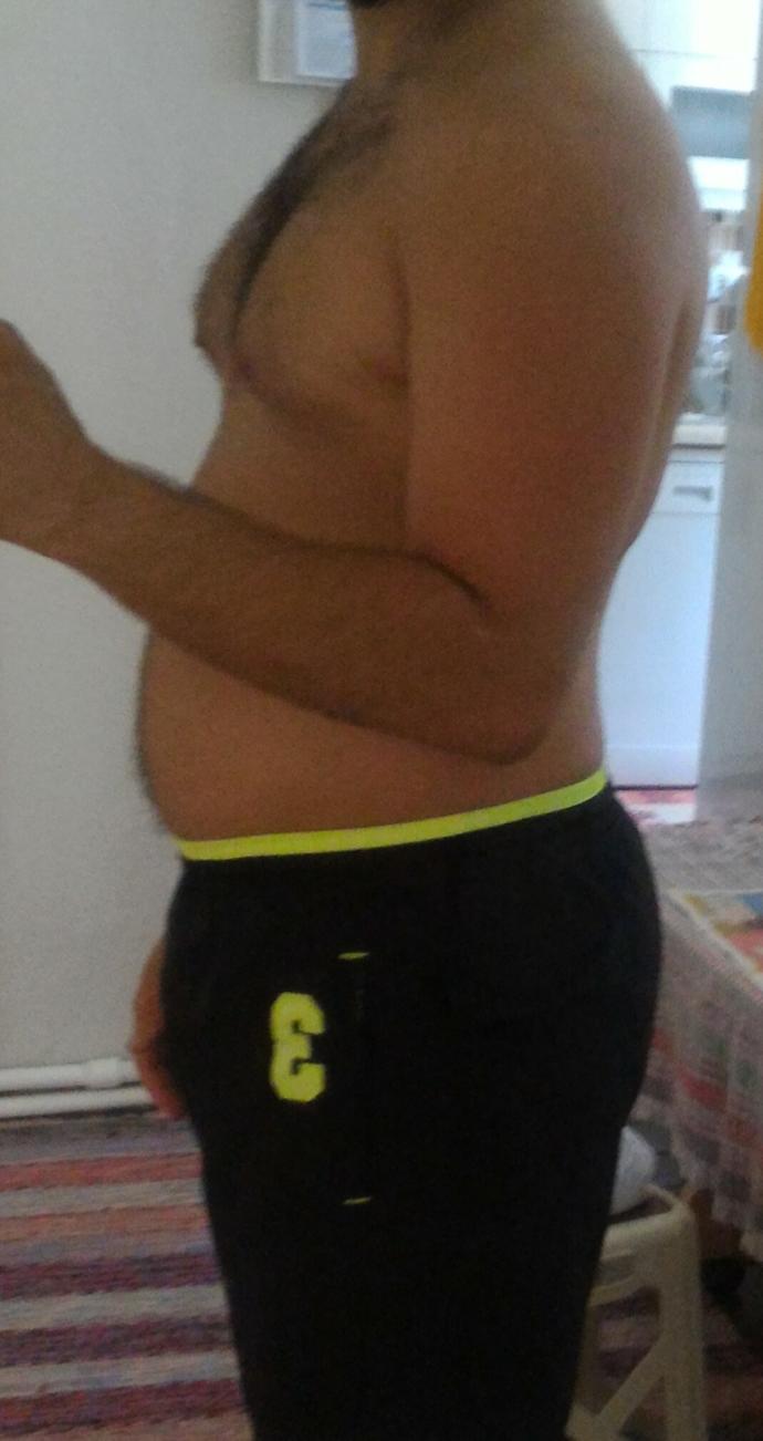 Bendeki jinekomasti sadece sporla geçer mi?