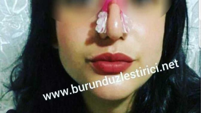 Burun düzleştirici aparatlar işe yatıyor mu?