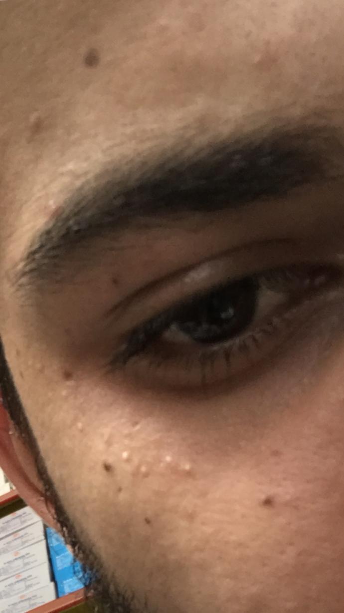 Ya bu siyah noktamı benmi nasıl,nerden aldırılır fotoğraftakiler ?