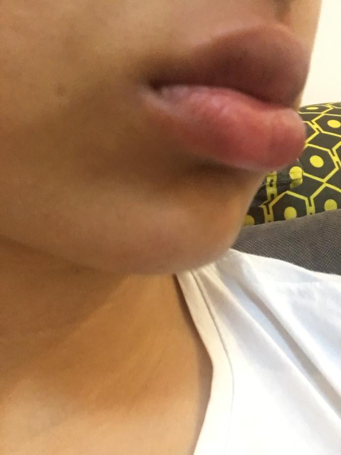 Alt dudağım önde duruyor ve dudaklarım kalın olduğu için çoook kötü gözüküyor sanki silikonlu gibi napmam gerek (resimli) 😞 ?