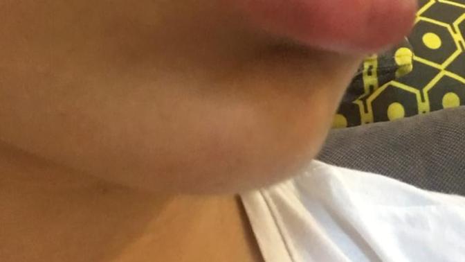 Alt dudağım önde duruyor ve dudaklarım kalın olduğu için çoook kötü gözüküyor sanki silikonlu gibi napmam gerek (resimli) 😞 ?