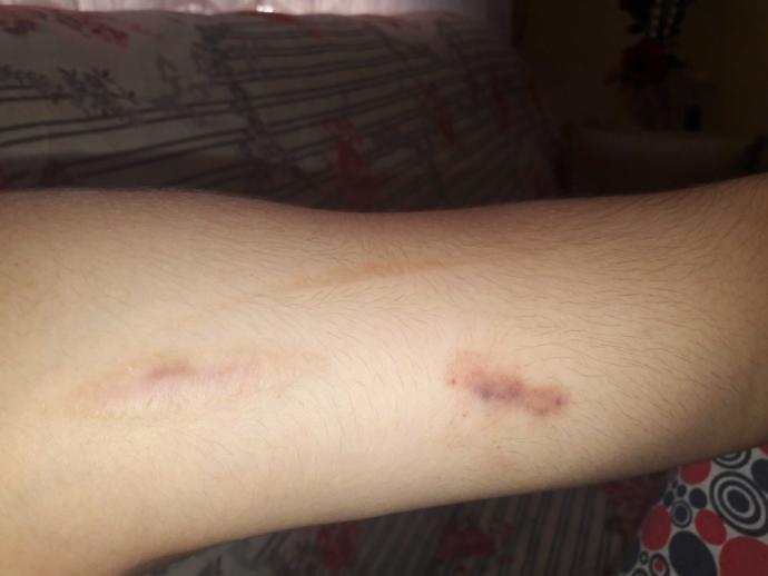 elimde bir yara çıktı sizce ne egzamamı yoksa mantar mı..??