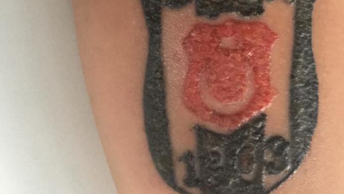 Dövmem iltihaplanmış mı , ne yapmam gerekiyor acill?