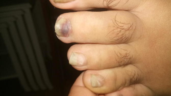 Tırnağım morardi ama acimiyor?