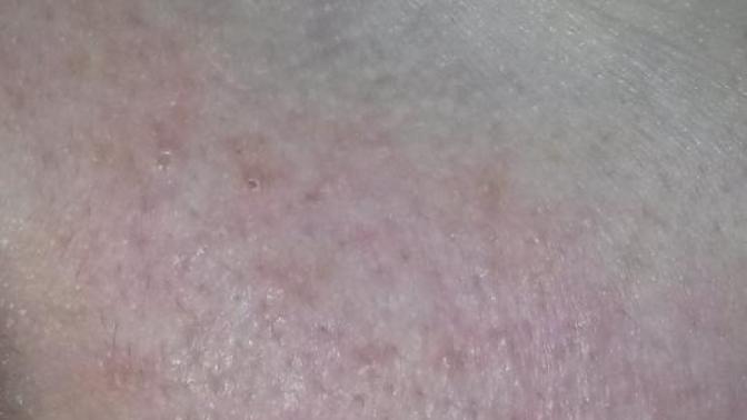 Yüzümde böyle  bir  kızarıklık var sizce çok mu kötü duruyo? Flasla cektim?