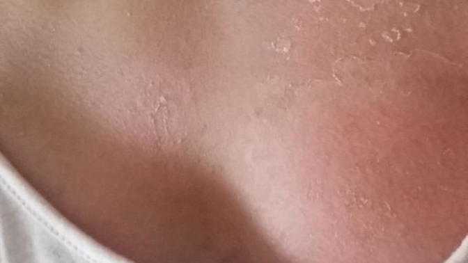 Vücudum soyuldu. İzleri ne zaman geçer kötü duruyor?
