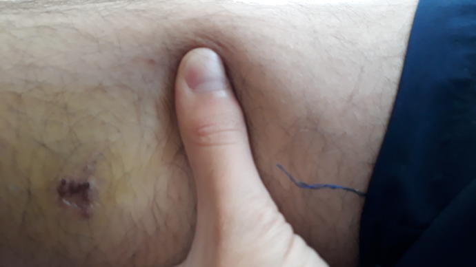 Bacagımdaki yaranın etrafı neden sapsarı oldu ?