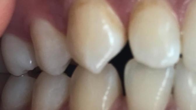 Acil yardimm! Diş lekesi mi yoksa çürüme başlangıcı mi?