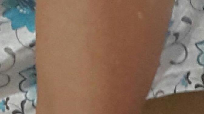 Üst bacağım neden böyle duruyor?