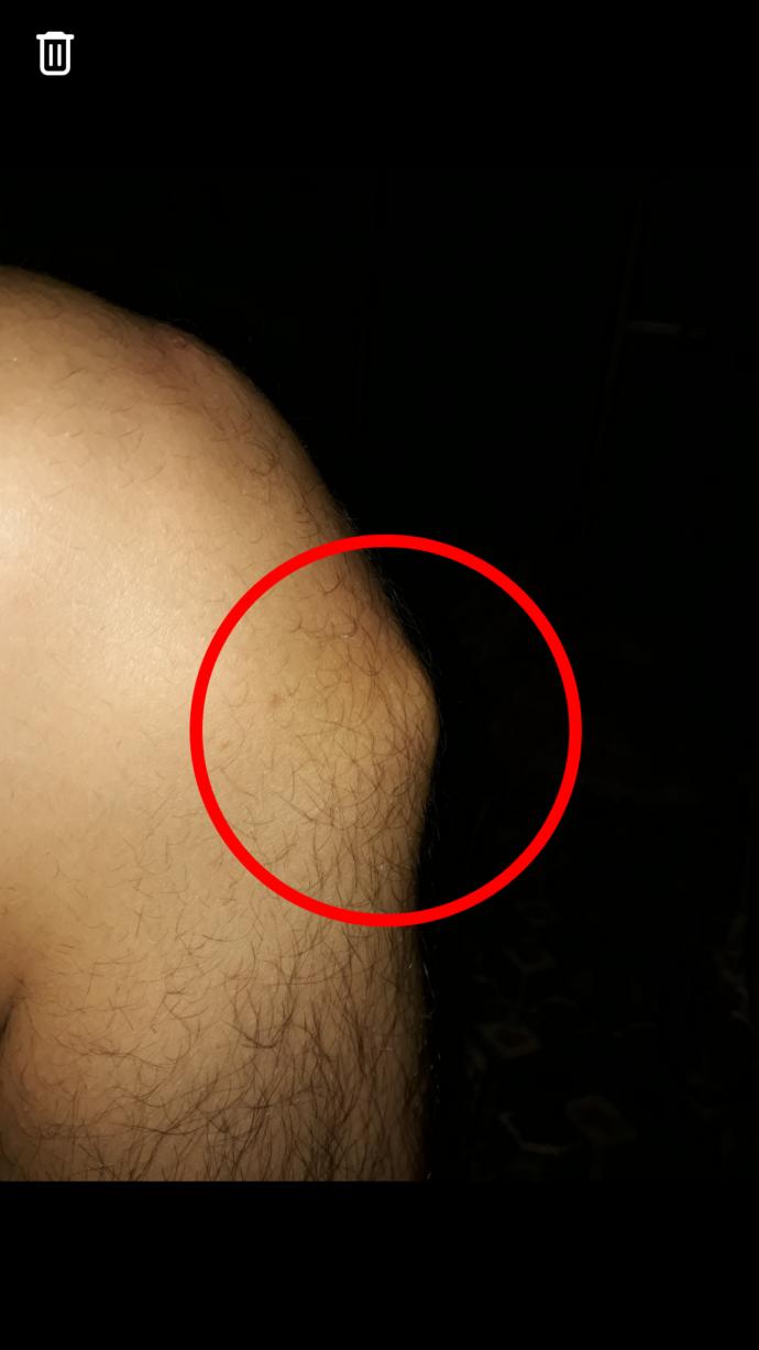 Arkadaşlar dizimde sislik var uzun zamandır ve her doktora gitmemde  bir  fayda goremedim tedavi olamadım sizce nedir bu ?