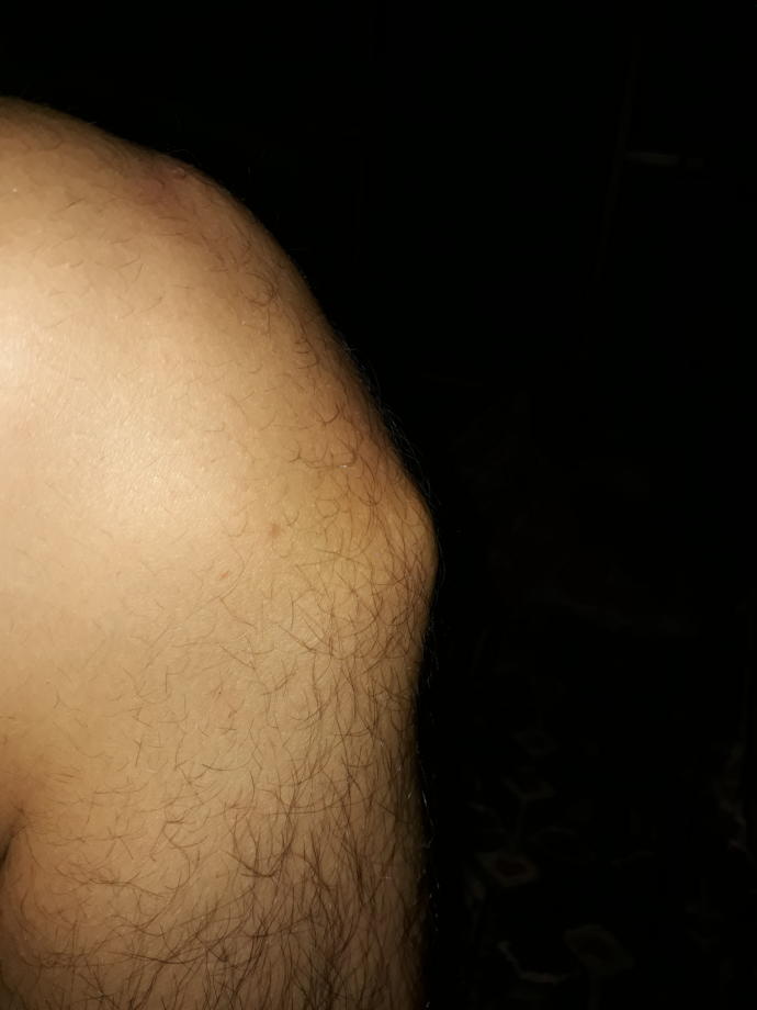 Arkadaşlar dizimde sislik var uzun zamandır ve her doktora gitmemde  bir  fayda goremedim tedavi olamadım sizce nedir bu ?