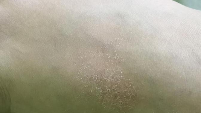 Arkadaşlar cildimde neden böyle birşey oldu  bir  yardımcı olur musunuz nazar mı acaba?