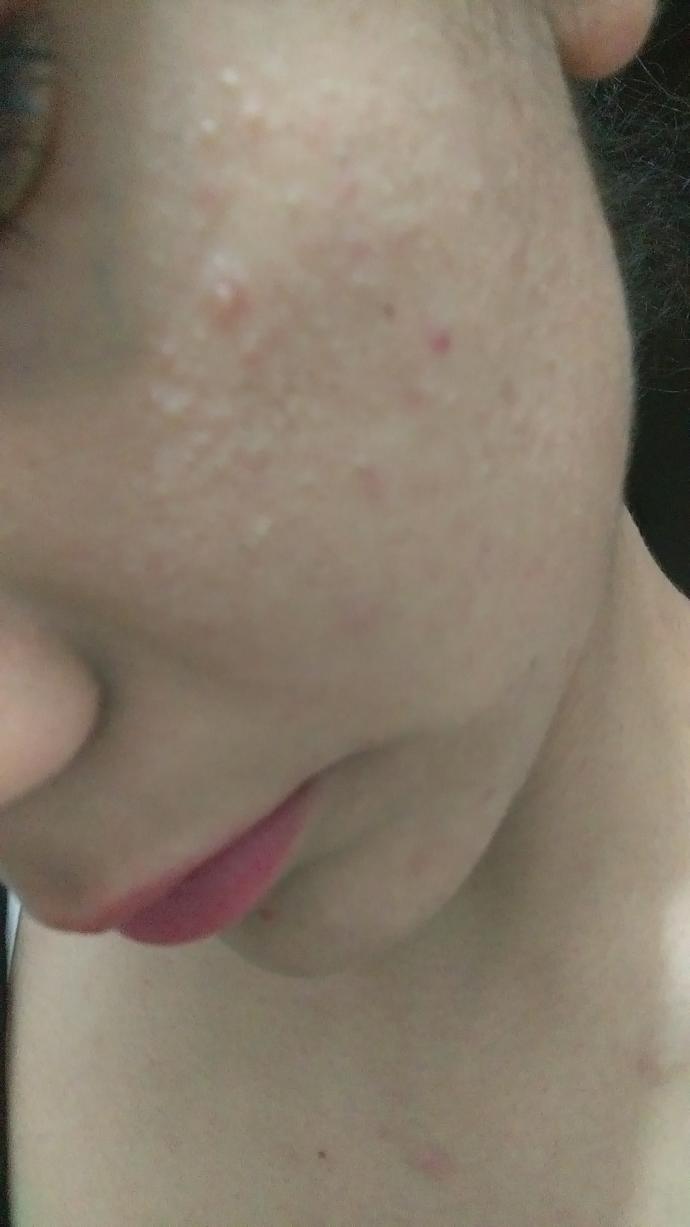 Sizce bu sivilce mi her neyse normal mi (fotograflı)?