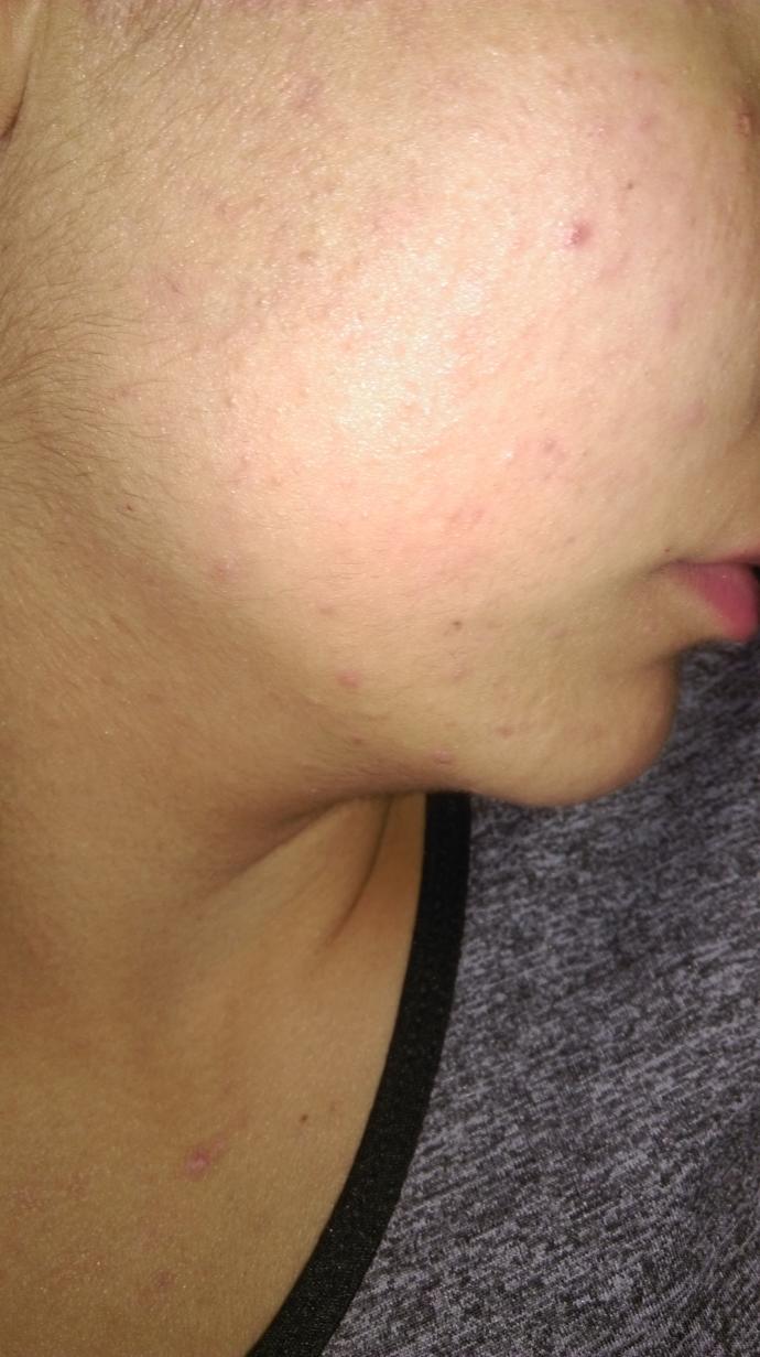 Sizce bu sivilce mi her neyse normal mi (fotograflı)?