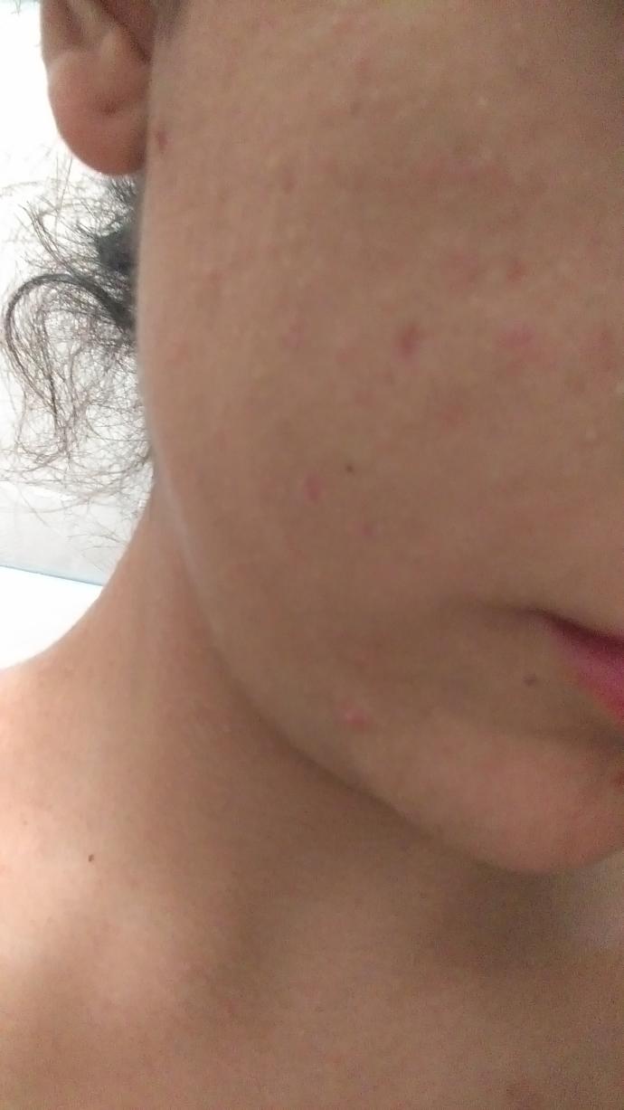 Sizce bu sivilce mi her neyse normal mi (fotograflı)? 