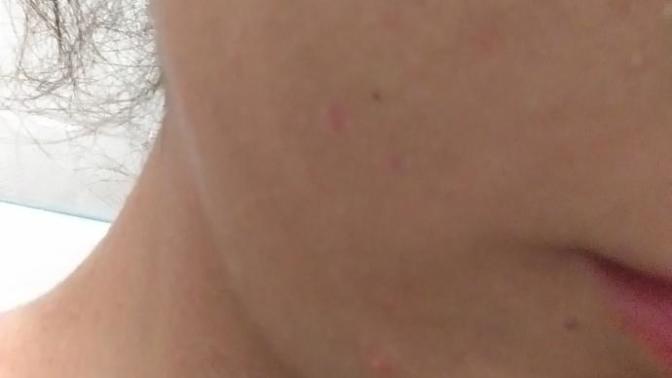Sizce bu sivilce mi her neyse normal mi (fotograflı)?