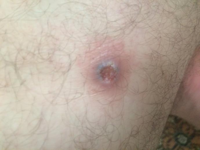 Babamın bacağında bundan var aranızda bundan olan veya bir tanıdığında olan var mı?