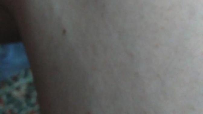 Yasim 19 Sizce bu bacaklardaki damar şişmesi nedir?